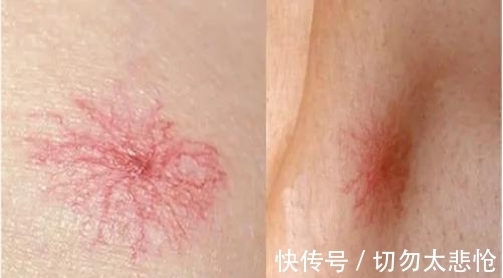 蜘蛛痣|每吃一口近似在肝上打洞，院士呼吁：1“下酒菜”，或比肥肉还伤肝