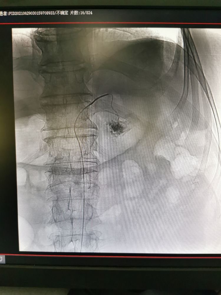 胃溃疡|一碗肉皮引发消化道大出血，胃溃疡老人经历“生死劫”