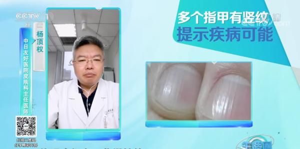 杵状甲|请低头:长这几种指甲的人注意了