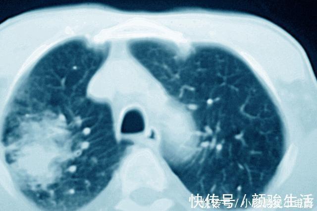 手术切除|为什么医生总是让癌症患者做CT检查?三大作用,你可能不了解