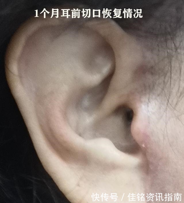 医生 维持时间短、价格贵、留疤,拉皮手术最常被问的问题,医生有话说!