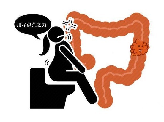 粪便|大便“先硬后软”是大肠癌征兆?医生忠告,4种异常便别掉以轻心