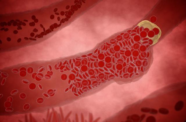 血压|血压高到什么程度时,容易发生脑出血预防脑出血要注意的4点