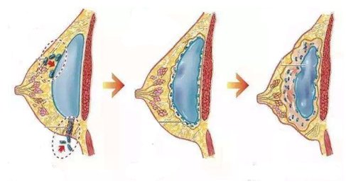 包膜 假体隆胸手术前必须知道的手术风险