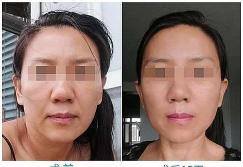 做超微创小切口提升手术，我的顾虑和感受