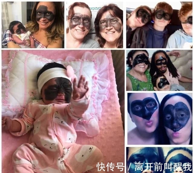 面具|7个月婴儿脸上因巨大黑色胎记爆红!像带着“蝙蝠侠”面具!