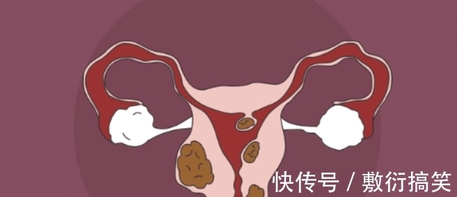 性生活|子宫“钟爱”一种水，平时敞开喝，散瘤清宫，子宫肌瘤节节败退