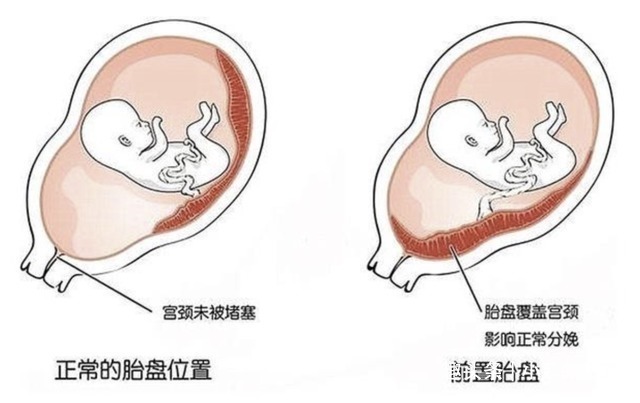 叶酸|孕妇几个月开始“显怀”呢过早显怀一般有这3种原因，你中了吗