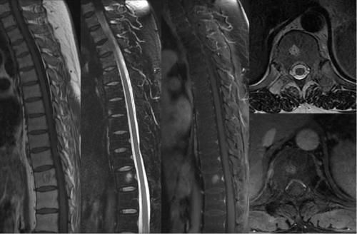 椎体|脊柱常见肿瘤及肿瘤样病变的几种影像学表现,你都见过吗?