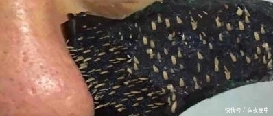 鼻子上的“白米粒”越挤越多,皮肤还会凹下去,原来是它的分泌物
