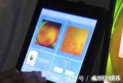 视网膜|危险！五旬阿姨一个喷嚏，差点失明…这些人都是高危！