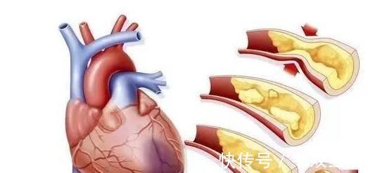 血栓|这4种食物比肥肉还升血脂，尽量少吃点，有助于保护血管!