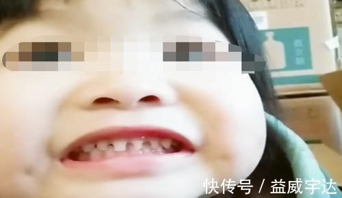 医生|2岁宝宝长出“鲨鱼牙”,妈妈慌忙带娃就医,医生:夜奶惹的祸