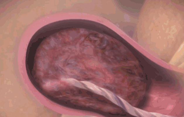 子宫|产后子宫恢复得好不好,看这4个指标