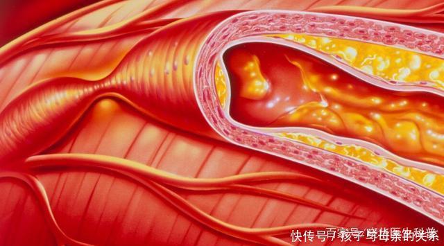 风险|50岁后,每十年脑梗风险增加一倍,医生:坚持3件事,血管才更好