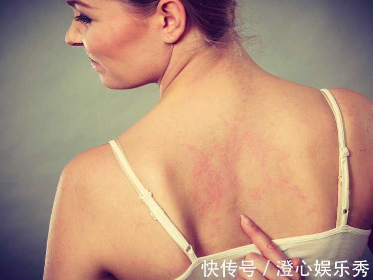 牙痛|“有病没病,防风通圣”:除了止痒外,防风通圣丸还有6种妙用