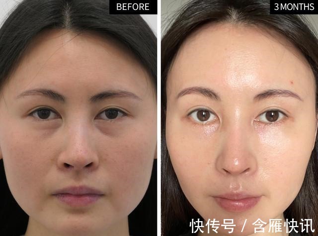 泪沟 求美者很想撤回的照片,真实记录泪沟、鼻修复术后3个月效果变化!