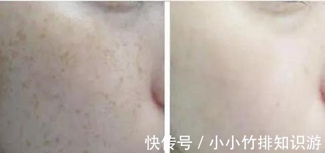 胶原蛋白 bb光和光子嫩肤的区别!