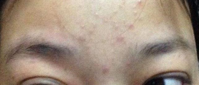 眼角膜|血脂高不高,看脸便知晓?脸上出现4大表现,要注意降低血脂了