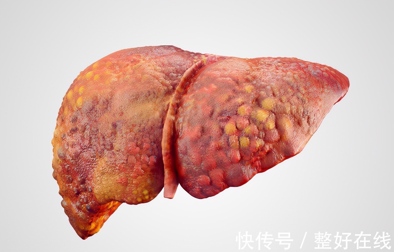 日常生活中|得了肝硬化怎么办?专家饮食上给你推荐“4招”,帮你缓解肝硬化