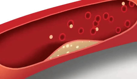 中老年人|中老年人颈动脉斑块，吃他汀类药物可以消失吗？医生为您讲清楚