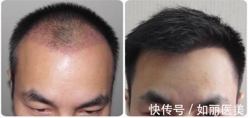 发际线 发际线种植术后原来需要这样护理!正确增加毛囊存活率