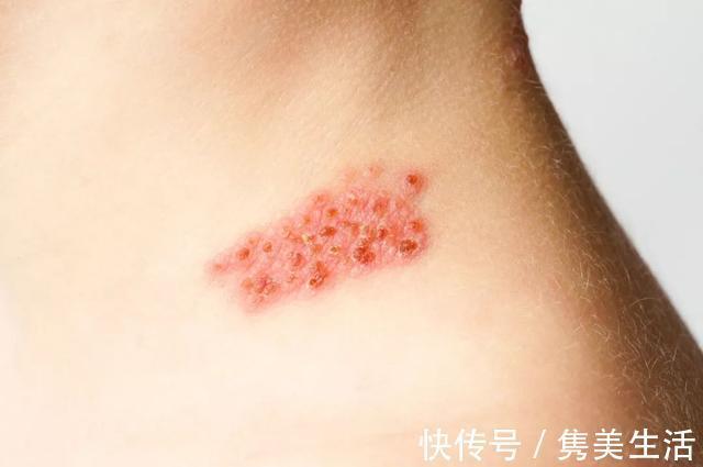 恶性肿瘤|癌症来临时,皮肤会出现4个变化,希望你可以及时知晓