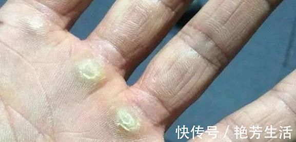 疾病|脚上长“茧子”和疾病有关?若脚上出现4种茧子,一定要留意了!