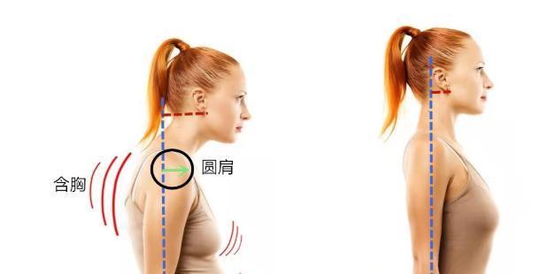 治疗|最容易忽视的颈肩痛,是颈椎病?4种方法鉴别、9种治疗措施纠正