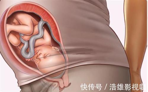 宝宝|最美胎记！双胞胎姐姐“消失”在腹中，化为胎记印在弟弟腿上