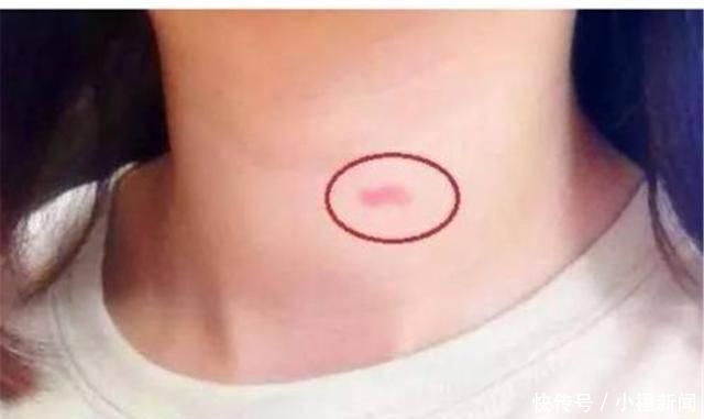 初中女儿脖子出现“草莓印”,妈妈没打没骂,一招挽救孩子恋爱观
