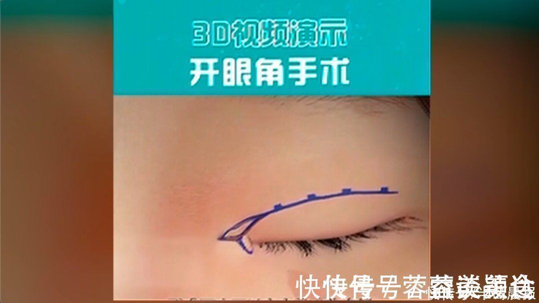 鼻子|花了近4万!女子取肋骨做的“欧美鼻”却变“妈生鼻”