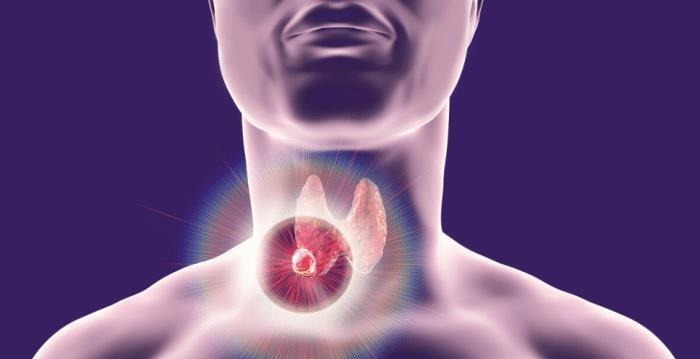 甲状腺结节患者|甲状腺结节患者能吃豆腐吗？医生：不碰这3种食物，结节或会好转