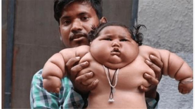 孩子|那个1岁体重高达45斤的孩子,太能吃父母担心养不起,如今怎样了