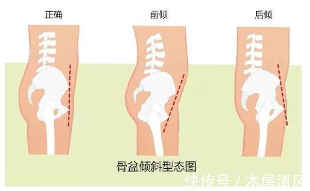 新妈妈|产后韧带松弛不宜穿高跟鞋 易加重骨盆劳损