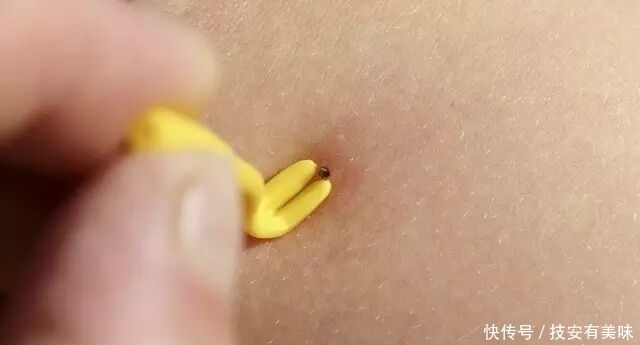 警示|警示:“螨虫脸”的人,3个感受很明显,说明螨虫在脸上爆发了!