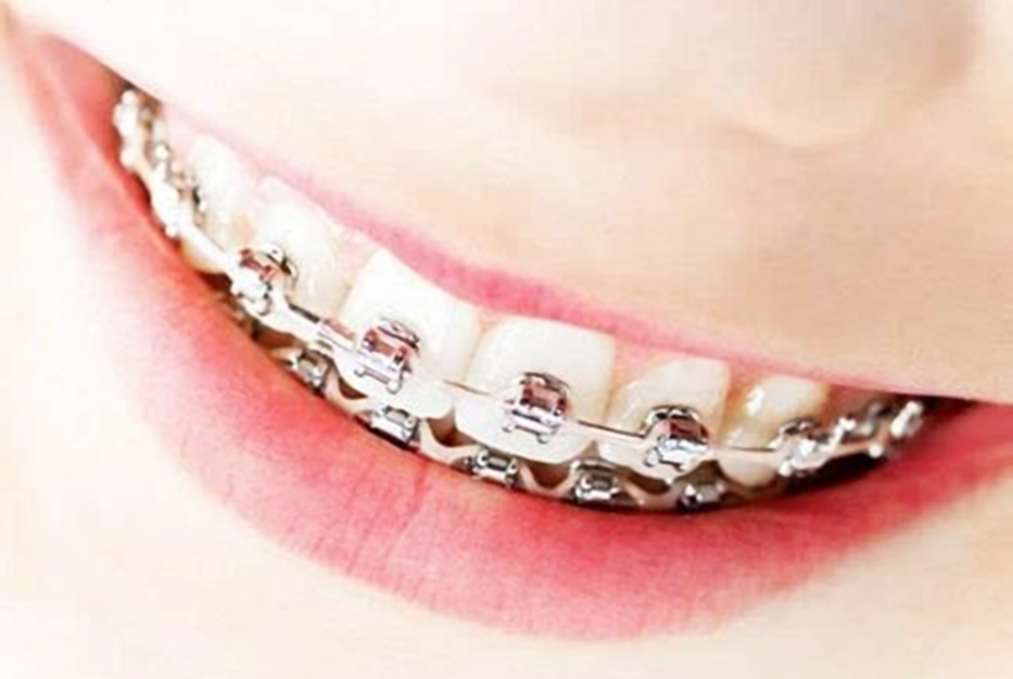 家长|好不容易等到宝宝换牙期，新牙却长歪了医生家长无知惹得锅