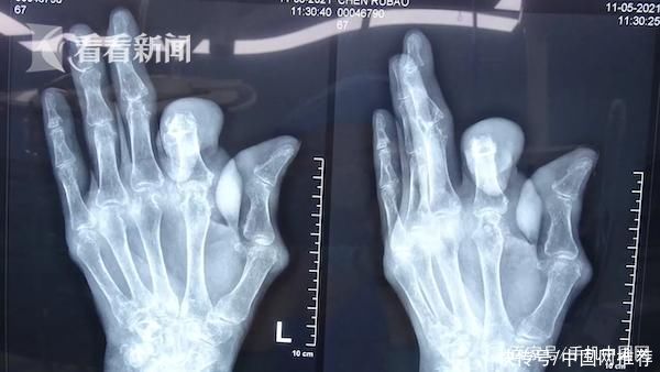 胰岛素抵抗|皮肤长出石头?六旬老伯长期吃海鲜手脚严重变形