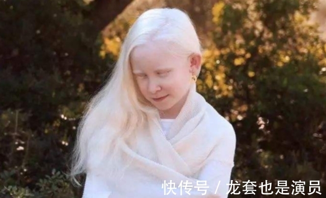 病人@非洲版“唐僧”:皮肤全白,血液比黄金还贵,死后遗骸能卖上百万