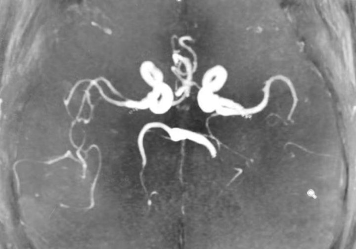 缺血性脑卒中|85岁突发急性脑梗,静脉溶栓联合血管内介入治疗挽救生命