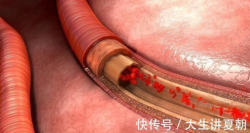 回事|血常规检查,这3个指标别不当回事,身边小事或与健康息息相关