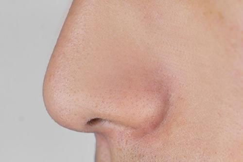 鼻子上挤出的白色丝状物，是螨虫分泌物吗？该如何清理才对？