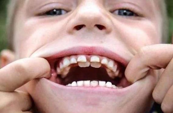 男孩|4岁男孩长出双排牙,只因父母太过“细养”孩子,医生太无知