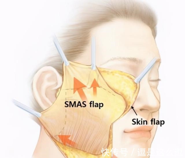 拉皮 做拉皮手术求美者都会有的10个顾虑！