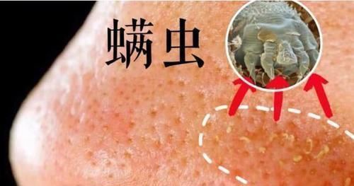 越来越|毛孔越来越大,是螨虫把你的脸当成寄宿地,3个方法教你摆脱困扰