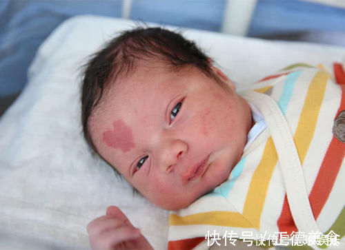 小张|孕期不经意的这几种行为,很容易让“胎记”找上宝宝,孕妈别大意