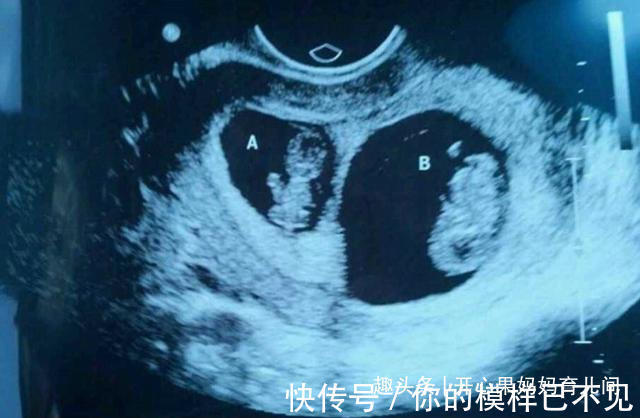 畸形|每5分钟就有一个畸形宝宝出生,孕期有6种食物会致畸,孕妈别碰