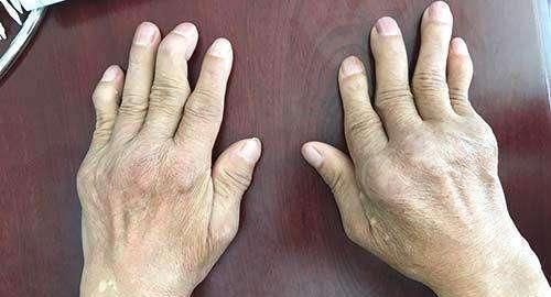 坏死|风湿科主任尿酸偏高的人,3种调味料不要碰,否则关节会坏死