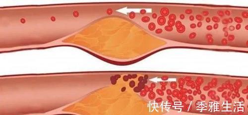 总胆固醇|高血脂的“天敌”已找到，常吃清理血管垃圾，血脂悄悄往下降