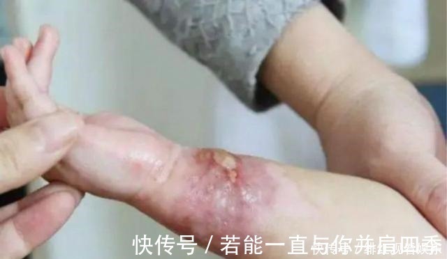 牙膏|孩子烫伤后最佳救治时间只有90秒,第一步该做啥很多父母都做错